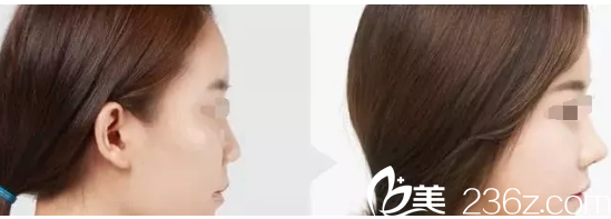 膨體隆鼻案例 膨體隆鼻案例