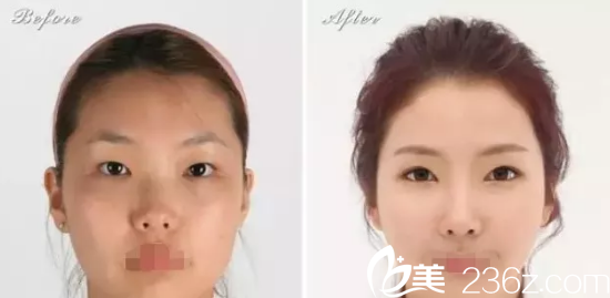 朝天鼻整形案例 朝天鼻整形案例