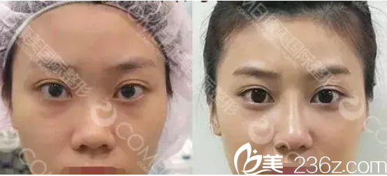 蒜頭鼻整形案例 蒜頭鼻整形案例