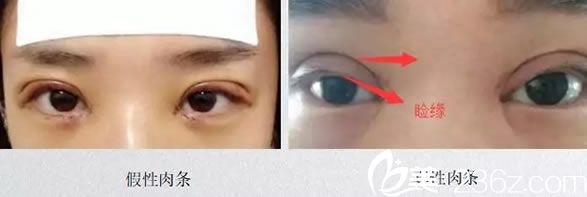 如何區(qū)分雙眼皮手術(shù)后的真假性肉條