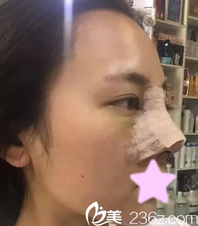聊城韓美倪景輝醫(yī)生給我做鼻綜合后第3天照片 聊城韓美倪景輝醫(yī)生給我做鼻綜合后第3天照片