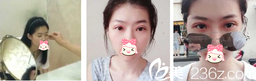 割雙眼皮術后 割雙眼皮術后