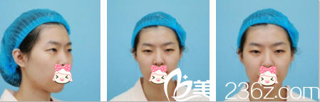 術前雙眼無神 術前雙眼無神