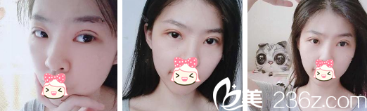 拆完線的雙眼皮 拆完線的雙眼皮