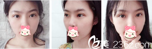 <!--<i data=20240703-sp></i>-->萍醫(yī)生割雙眼皮術后一個月 <!--<i data=20240703-sp></i>-->萍醫(yī)生割雙眼皮術后一個月