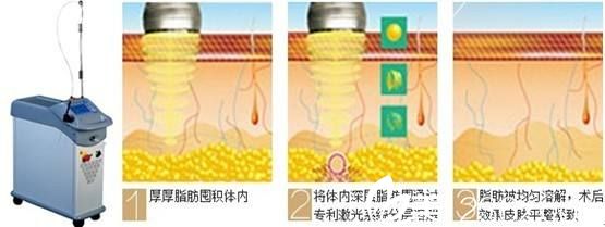 雅芳亞采用CGF自體脂肪移植技術(shù)