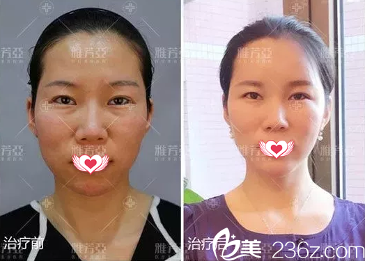 石家莊雅芳亞自體脂肪填充案例