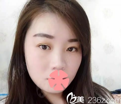 在福州臺江整形醫(yī)院隆鼻術(shù)前照 在福州臺江整形醫(yī)院隆鼻術(shù)前照