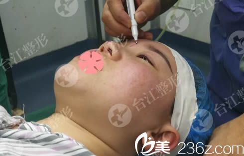 鼻整形前設(shè)計方案 鼻整形前設(shè)計方案