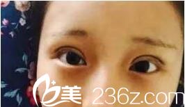 術(shù)后兩天效果