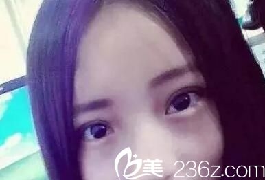 術(shù)后7天效果