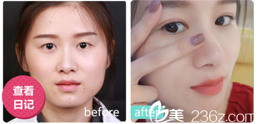 深圳美萊林登文做的雙眼皮<span style= 深圳美萊林登文做的雙眼皮<span style=