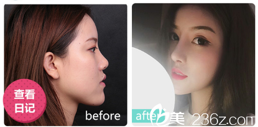 深圳美萊整形醫(yī)院梁曉健做的隆鼻<span style= 深圳美萊整形醫(yī)院梁曉健做的隆鼻<span style=