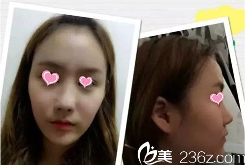 自體脂肪填充全臉手術(shù)前 自體脂肪填充全臉手術(shù)前