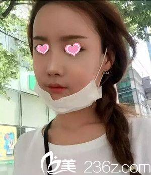 自體脂肪豐蘋果肌后13天 自體脂肪豐蘋果肌后13天