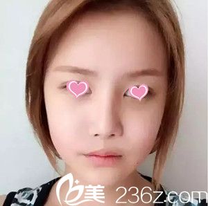 史希杰給我做自體脂肪全臉手術(shù)20天了 史希杰給我做自體脂肪全臉手術(shù)20天了