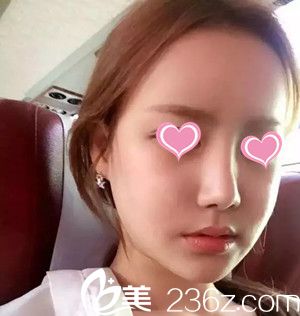 自體脂肪豐鼻唇溝后20天 自體脂肪豐鼻唇溝后20天