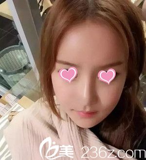 史希杰給我設(shè)計(jì)的自體脂肪填充方案是：填充額頭+太陽(yáng)穴+蘋(píng)果肌+鼻唇溝，來(lái)看看術(shù)后效果