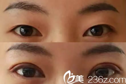 宜賓韓美整形雙眼皮案例效果圖