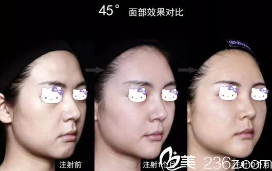 艾莉薇玻尿酸注射真人案例效果對(duì)比