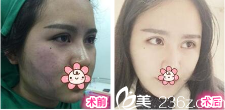 貴陽美貝爾侯舍予面部吸脂案例