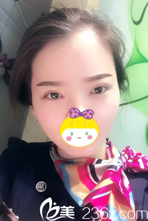 術(shù)后3天雙眼皮微腫 術(shù)后3天雙眼皮微腫