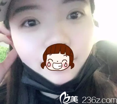 眼綜合7天后雙眼皮消腫 眼綜合7天后雙眼皮消腫