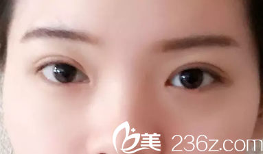 恢復(fù)16天后雙眼皮慢慢恢復(fù)中 恢復(fù)16天后雙眼皮慢慢恢復(fù)中