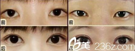 烏魯木齊伊麗莎白眼綜合效果對(duì)比圖