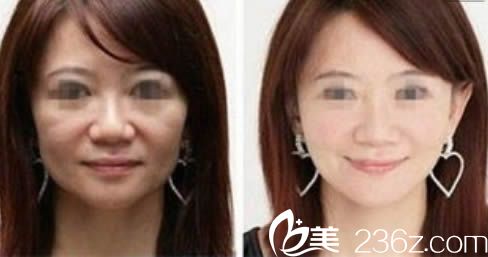 烏魯木齊伊麗莎白整形面部年輕化案例效果對(duì)比圖