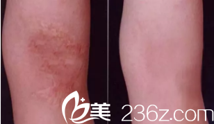 雅芳亞祛除燒傷疤痕案例 雅芳亞祛除燒傷疤痕案例