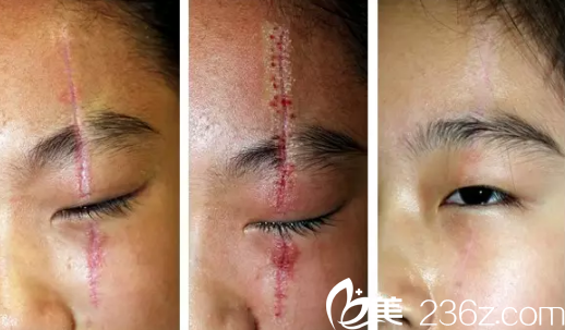 石家莊雅芳亞祛除刀疤案例 石家莊雅芳亞祛除刀疤案例