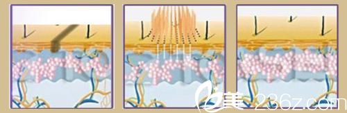 激光祛疤痕原理 激光祛疤痕原理