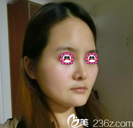 在北京印正山做面部脂肪填充前樣子 在北京印正山做面部脂肪填充前樣子