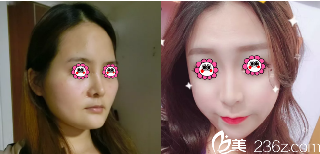 北京印正山面部脂肪填充前后對(duì)比效果 北京印正山面部脂肪填充前后對(duì)比效果