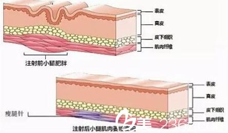 瘦臉除皺不適合那些人