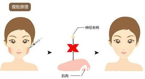 打瘦臉老了有什么影響