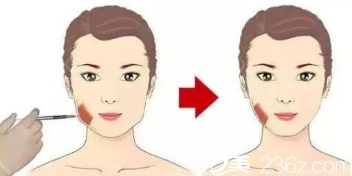 打瘦臉不良影響：不能頻繁的打