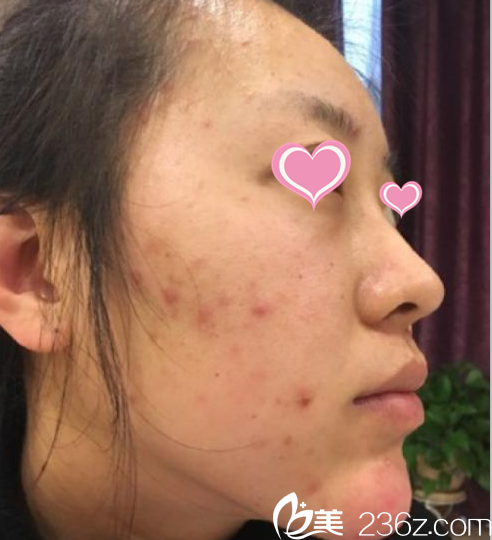 在北京知音取出面部生長(zhǎng)因子前樣子 在北京知音取出面部生長(zhǎng)因子前樣子