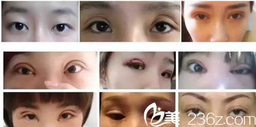 雙眼皮手術(shù)失敗案例