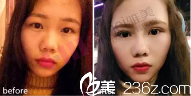 田芳斌眼部整形真人案例