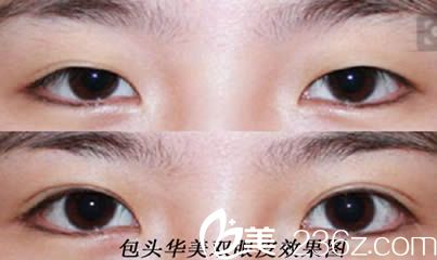 包頭華美整形雙眼皮案例效果對比圖 包頭華美整形雙眼皮案例效果對比圖
