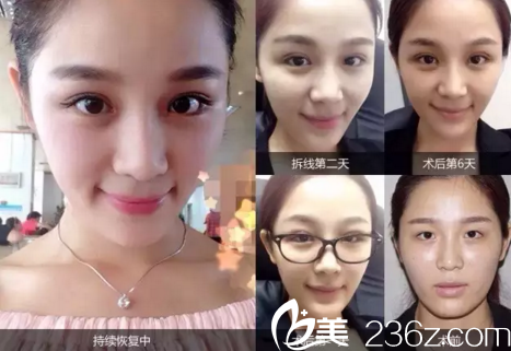 張姣姣眼部整形真人展示