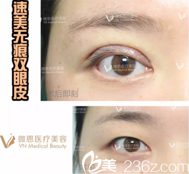 滕召勇速美無痕雙眼皮真人案例