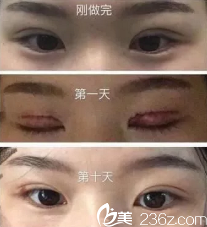 龍劍虹主任眼部整形真人效果對比