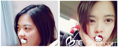 蔣松林院長眼部整形真人效果展示