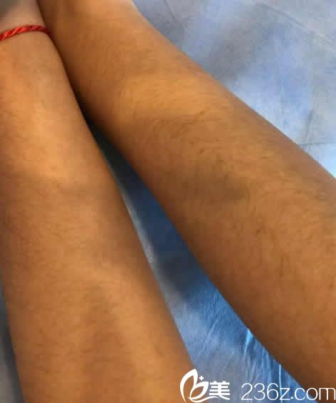 我在太原歐美蓮整形做激光脫毛前的照片 我在太原歐美蓮整形做激光脫毛前的照片