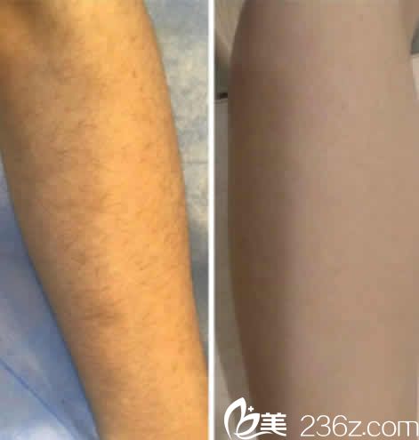 想要脫毛的朋友們可以參考我在太原歐美蓮整形做的激光手臂脫毛效果圖