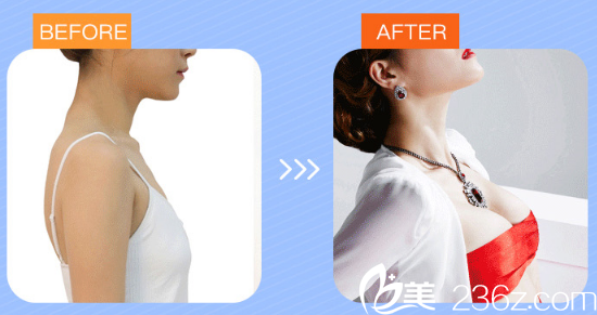 湛江澳泰整形醫(yī)院張維華做的隆胸案例 湛江澳泰整形醫(yī)院張維華做的隆胸案例