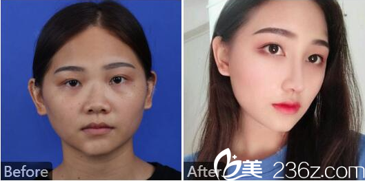 湛江澳泰整形醫(yī)院張維華隆鼻案例圖 湛江澳泰整形醫(yī)院張維華隆鼻案例圖